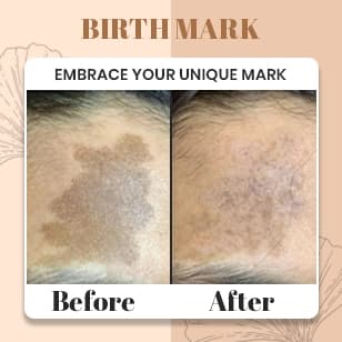 Birth Mark Treatment