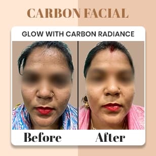 Carbon Facial