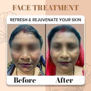 Face Treatment