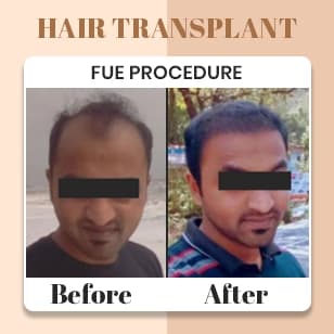 Hair Transplant 1