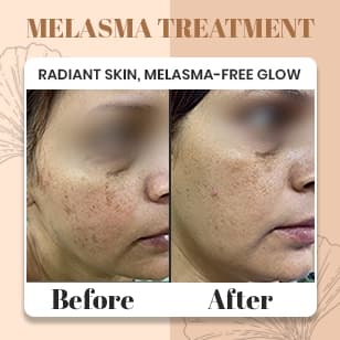 Melasma Treatment