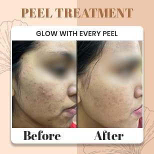 Peel Treatment