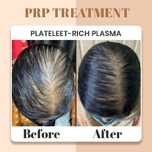 PRP Treatment