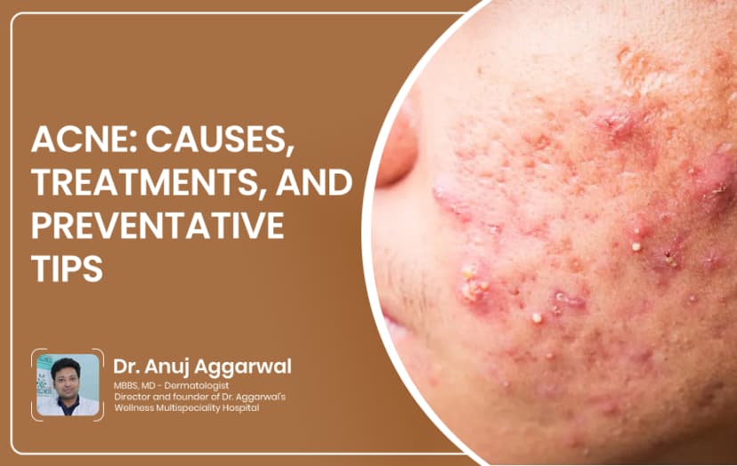 Acne: Causes, Treatments, and Preventative Tips
