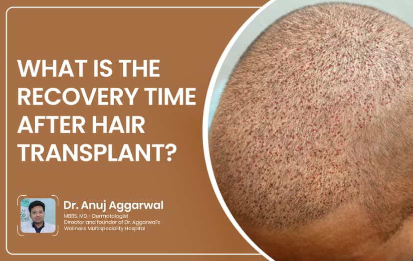 What Is the Recovery Time After Hair Transplant?